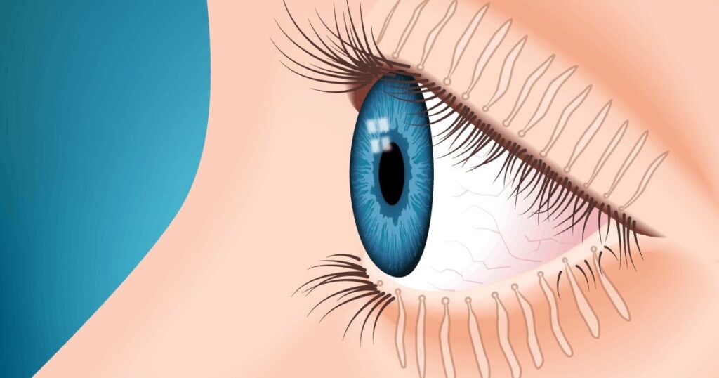 Meibomian Gland Expression (MGE)